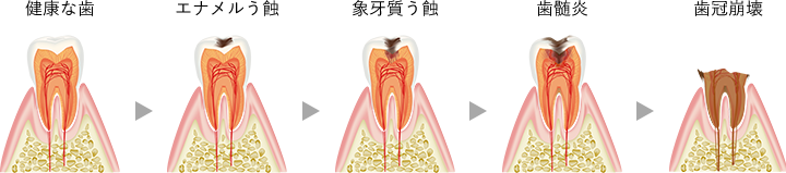 健康な歯、エナメルう蝕、象牙質う蝕、歯髄炎、歯冠崩壊